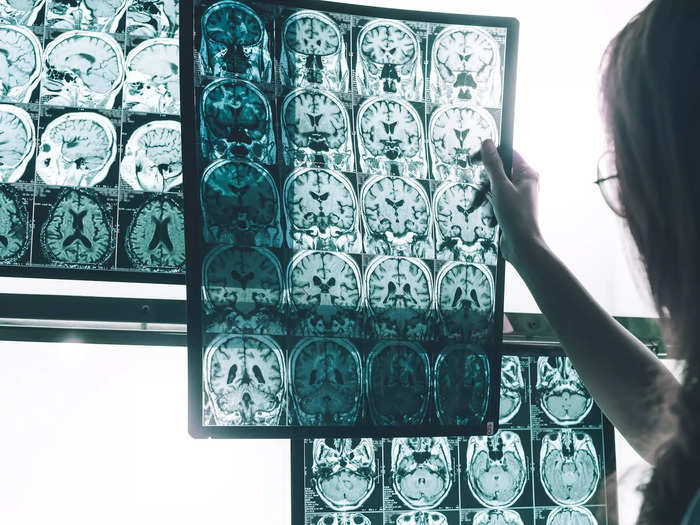 The drug is being studied in patients with early-onset Alzheimer