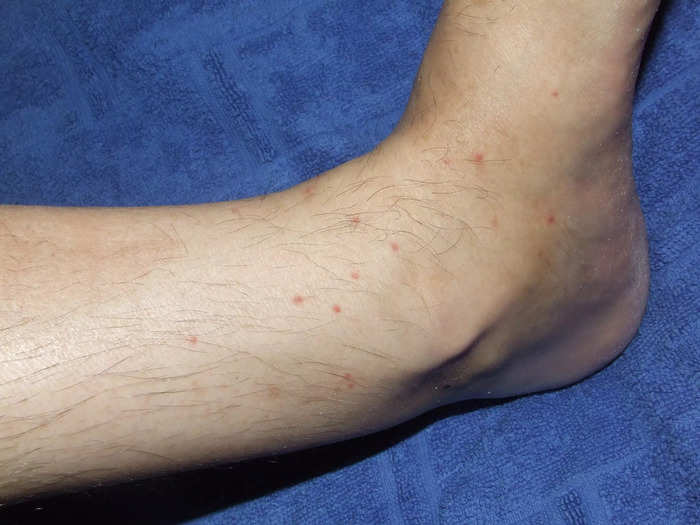 Flea bites are small and scattered.