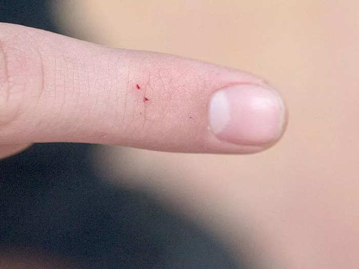 A black widow spider bite has two fang marks.