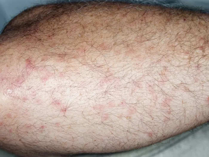 Midge or gnat bites look like mosquito bites.