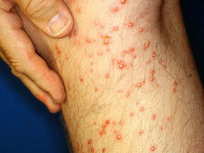 Ant bites are usually painful and can become infected.