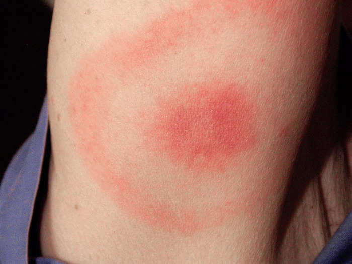 Dangerous tick bites sometimes look like a bullseye.