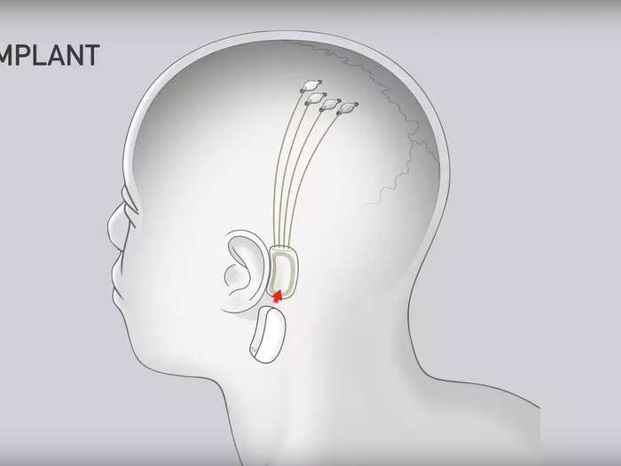 In a human, the Neuralink device is designed to sit behind the ear.