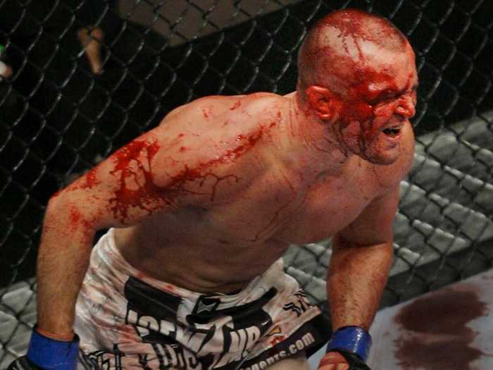 Chris Lytle after fighting Josh Koscheck