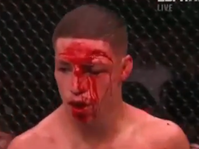 Diego Sanchez after fighting B.J. Penn