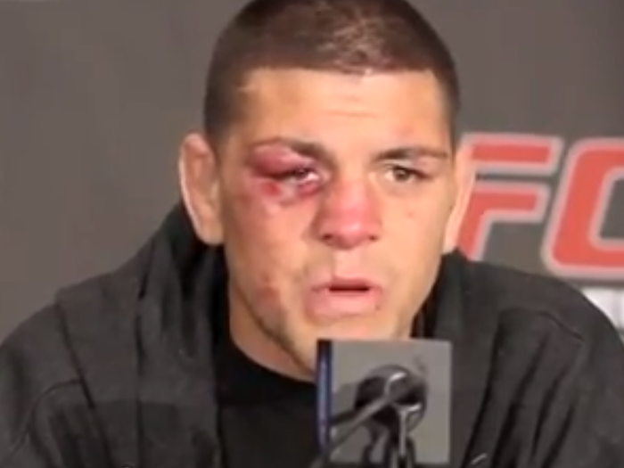 Nick Diaz after fighting BJ Penn