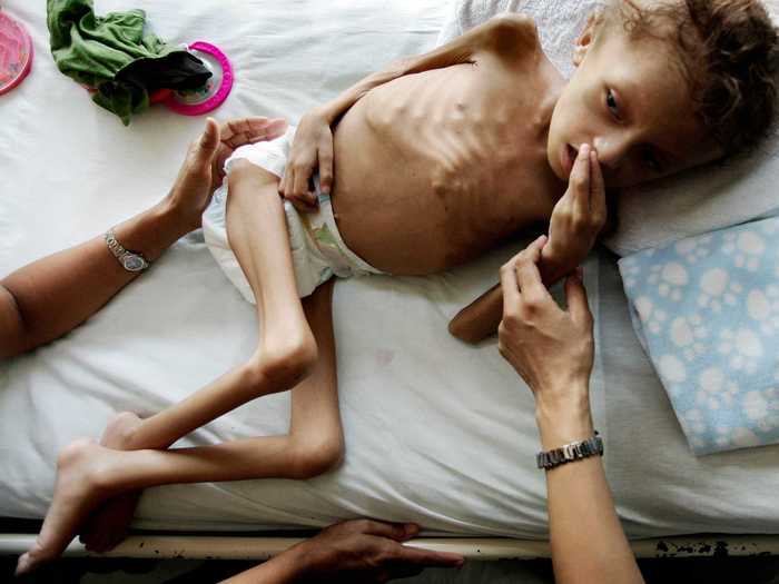 The poor living conditions arguably hit children the hardest. In Honduras, 2/3 of children live in poverty, and  8% are underweight. Social workers found Jason Lopez, 9, weighing only 17.6 pounds — a normal weight for a 2-year-old. Here, he recovers from severe malnutrition at a hospital in San Pedro Sula.