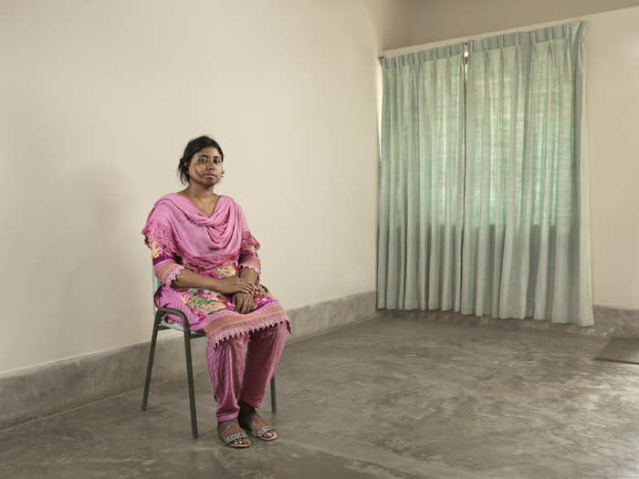 A portrait of a Bangladeshi woman disfigured by an acid attack.