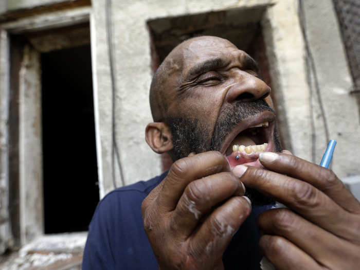 A homeless man displays a pin that holds his jaw together; he said he received it after being beaten and robbed while sleeping in the vacant row house seen behind him.