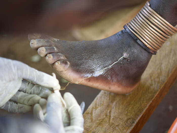 Guinea worm