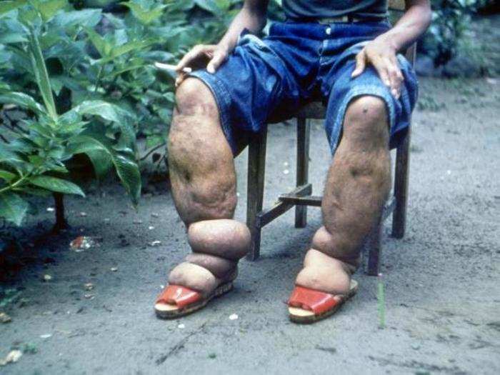 Lymphatic filariasis (elephantiasis)