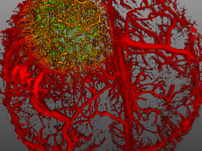 Live imaging of blood vessels (red) in a mouse brain with a tumor (yellow/green)