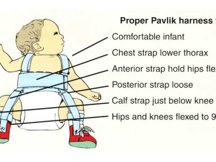 Whitman was born with a birth defect called dysplasia; her left hip lacked a socket, discovered as a newborn. She was strapped into a stiff metal brace with leather straps until age 3, when it was removed. It worked! She could walk and run normally.