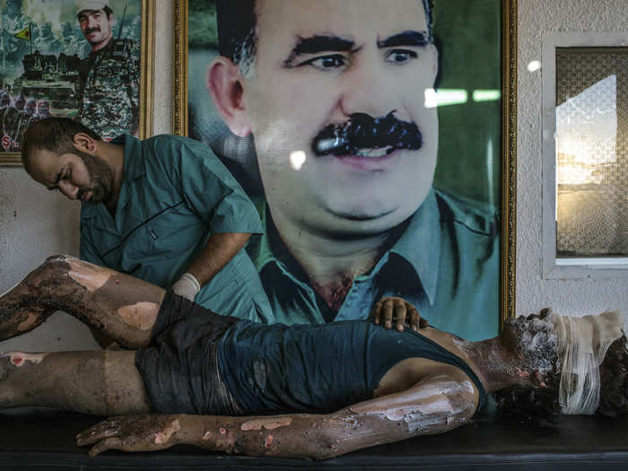 General News Singles, 1st prize: Mauricio Lima, Brazil — A doctor rubs ointment on the burns of a 16-year-old Islamic State fighter named Jacob in front of a poster of Abdullah Ocalan, the jailed leader of the Kurdistan Workers