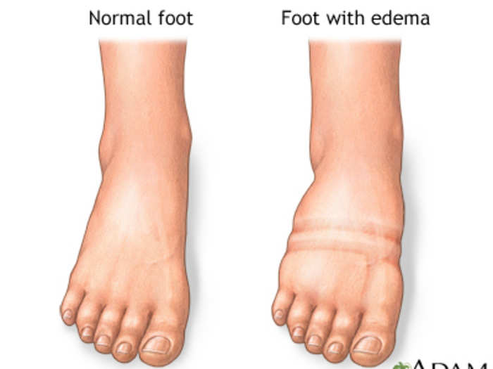 Water retention can also cause swelling of the hands, arms, and legs —  a condition called edema.