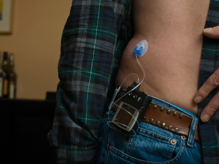 Most people who need insulin either inject it with a syringe, a pen, or an insulin pump (pictured here) that can deliver insulin as needed throughout the day.