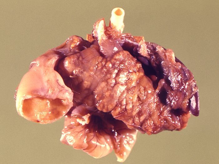 Back in the 1920s, researchers figured out that the pancreas was an important part of what was making diabetics so sick and got to work figuring out if they could make a treatment for them. Pictured here is an inflamed pancreas alongside the duodenum to its right, and the spleen to its left, in a rhesus monkey.