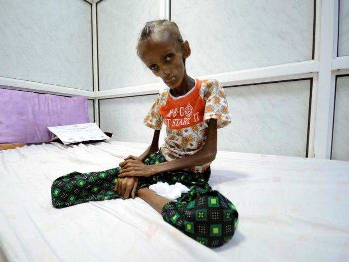 18 year-old Saida Ahmad Baghili, who is affected by severe acute malnutrition, sits on a bed at the al-Thawra hospital in the Red Sea port city of Houdieda, Yemen, on October 24.