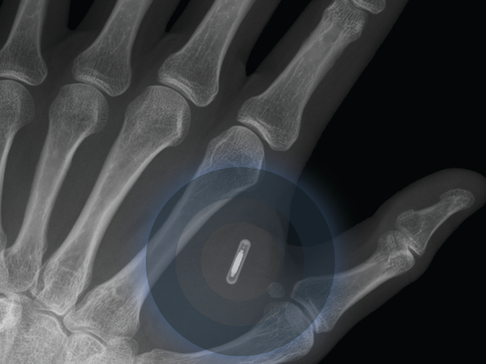 The first implantable mobile phone will become commercially available in 2025.