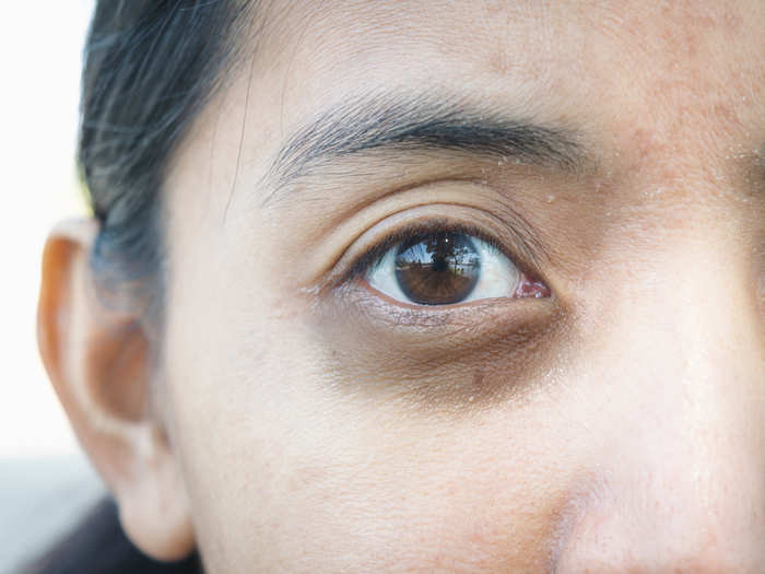 2. Dark circles will appear beneath your eyes in your 30s, but you can minimize them with targeted ointments.