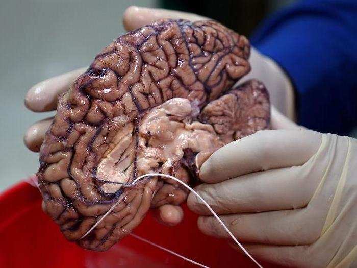 Each brain is cut in half upon arrival. One half sits in formaldehyde, but the other half ...