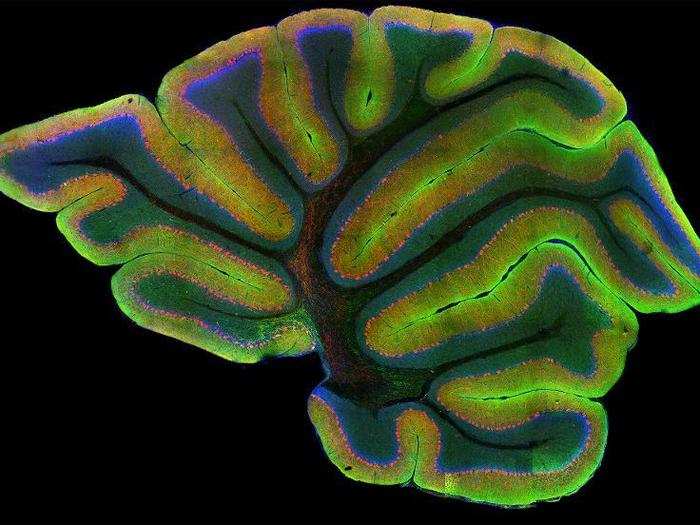 Part of a brain with nerve cells in red, nuclei in blue, and tau proteins in green.