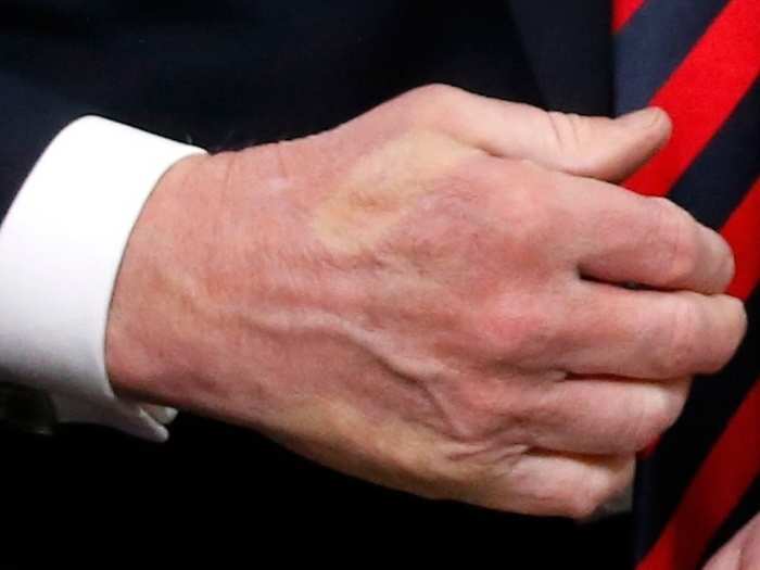 The thumbprint appeared very similar to the one Macron left from a handshake at the G7 Summit in June ...