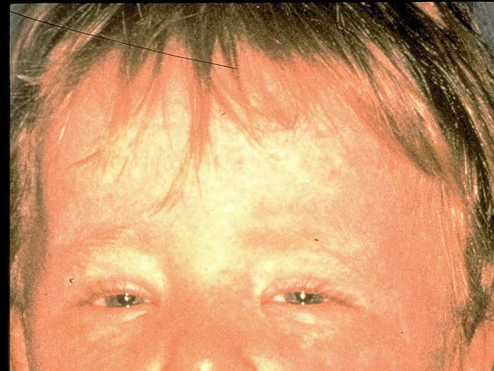 People with the measles may be sensitive to light, and about one in every 1,000 who catch the disease will die.