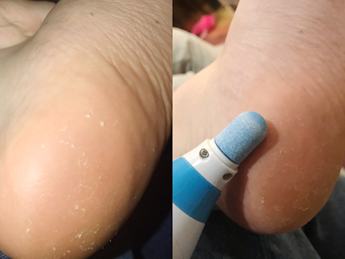 As much as I had apprehensions about sharing my callouses with the internet, a before and after showed that the product did a decent job at removing some dry skin.