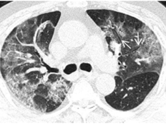 A Shanghai study also identified a mesh-like pattern called "reticulation," which is visible in this scan of a 75-year-old man.