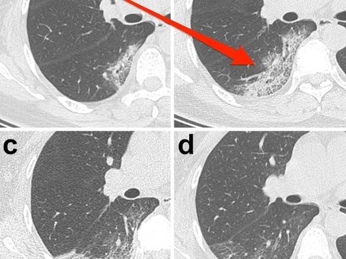 Some patients also exhibited a "crazy-paving pattern," which refers to little lines inside the ground-glass patches.