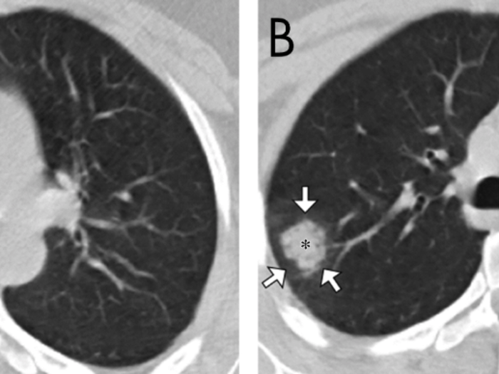 Scans from a 27-year-old woman who worked in Wuhan showed a "ground-glass halo" — white patches that surround a small nodule.