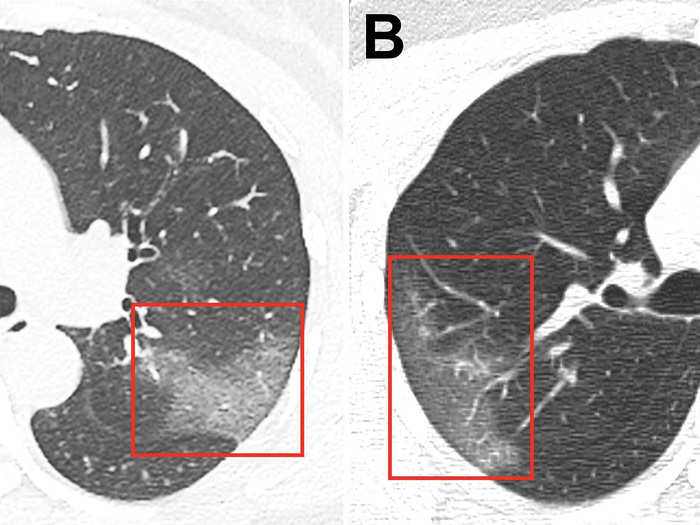 Many patients tended to worsen quickly. Their ground-glass patches became more pronounced after a few days.