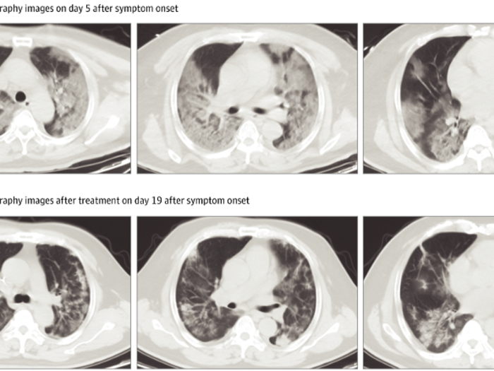 An analysis of nearly 140 coronavirus scans said patches of ground glass on both lungs were a hallmark of the virus.