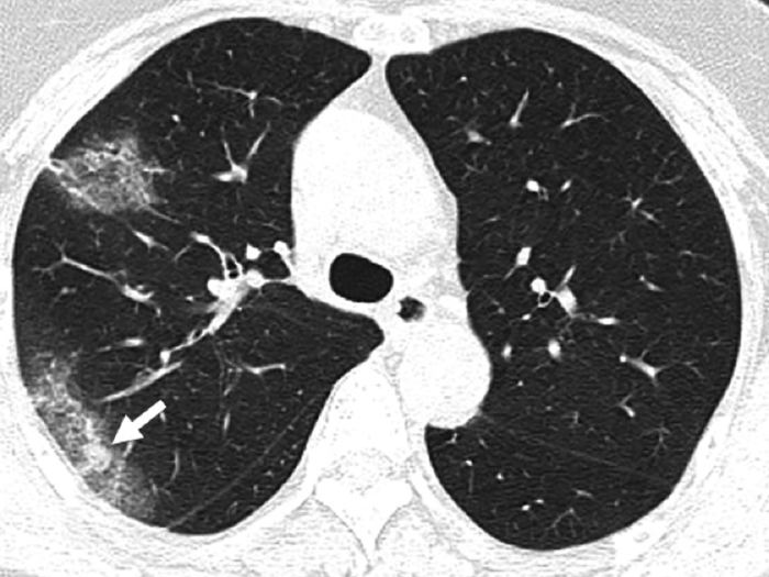 But coronavirus scans tend to have white patches that radiologists refer to as "ground glass opacity."