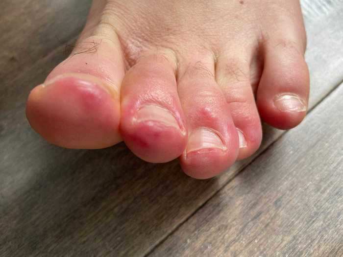 Dermatologists have reported seeing coronavirus patients with purple, swollen toes— what the medical community now calls "COVID toes."