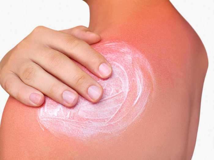 Sunburn can be treated with aloe vera or items you probably have in your fridge.