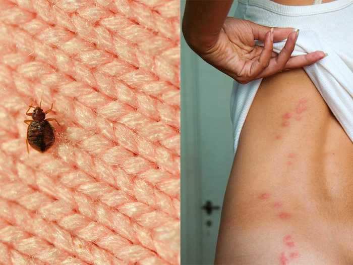 Bed bug bites