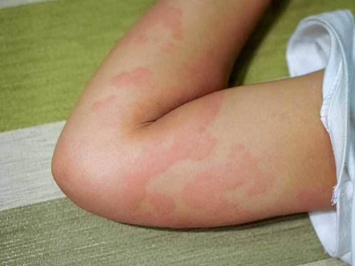 Hives can indicate a severe allergic reaction.