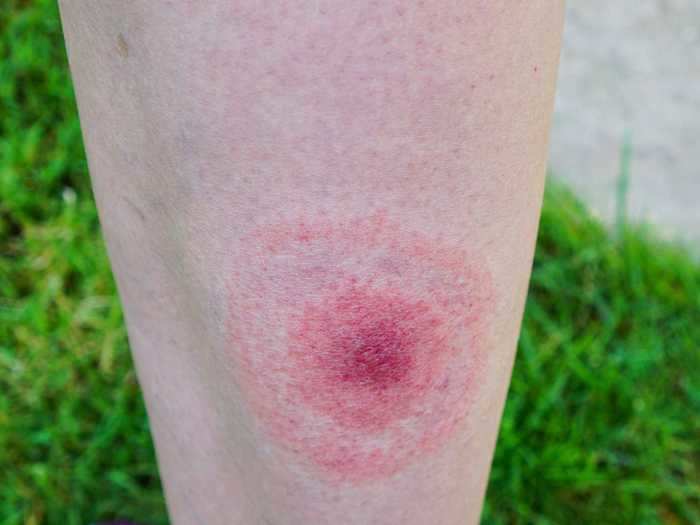 Look out for a target-shaped rash that could indicate Lyme disease.