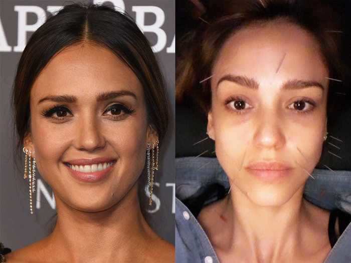 Jessica Alba snapped a selfie in the middle of an acupuncture session.