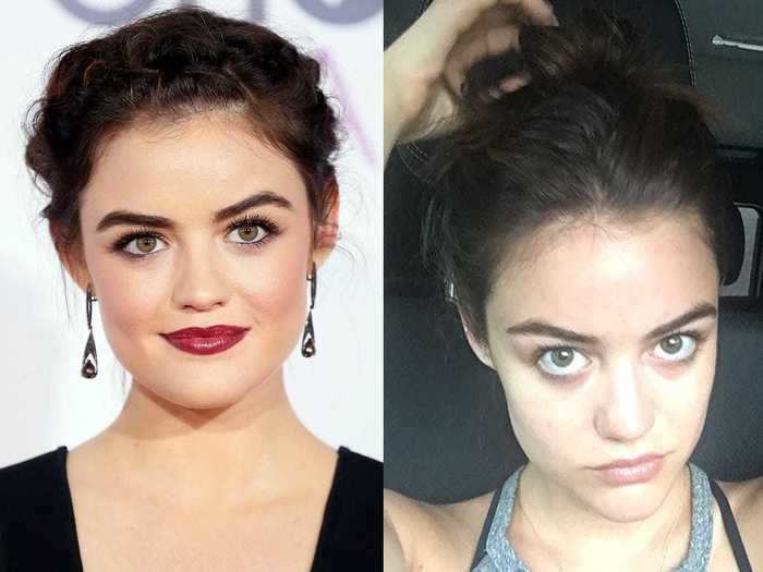 Lucy Hale got real about her dark, under-eye circles in July 2016.