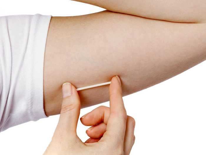 Those who used the implant, which is inserted into the upper inner arm, waited 2 menstrual cycles on average.