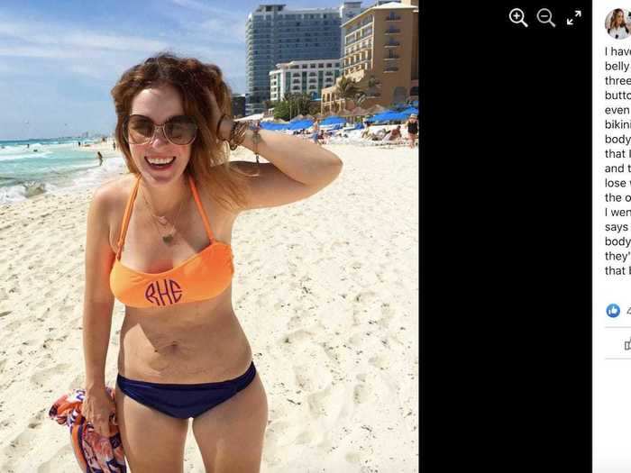 Hollis became famous in 2015 after posting a Facebook photo of herself that showed off her pregnancy stretch marks.