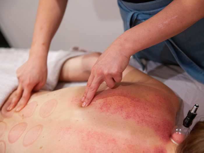 Lanshin said the redder the skin gets, the more the treatment was needed. My upper back, she said, was on the higher end of reactions she sees, and called it "satisfying" as a practitioner.