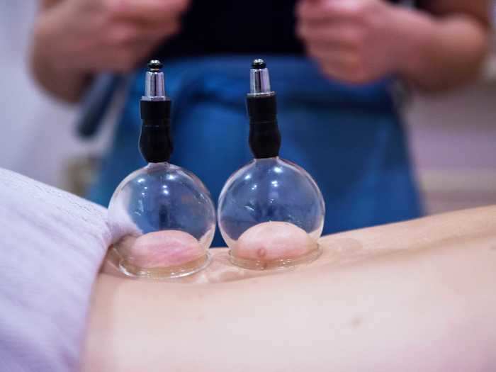 Cupping is a Chinese medicine therapy involving suction cups to promote blood circulation.