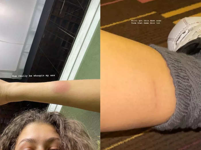 Zendaya still has a scar from her intense, physically-demanding intervention scene on episode five.