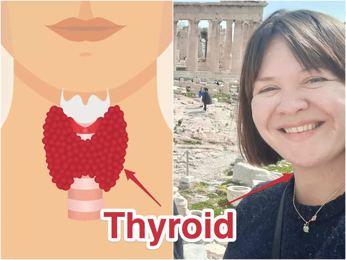 I have Graves disease, which messes up your thyroid.