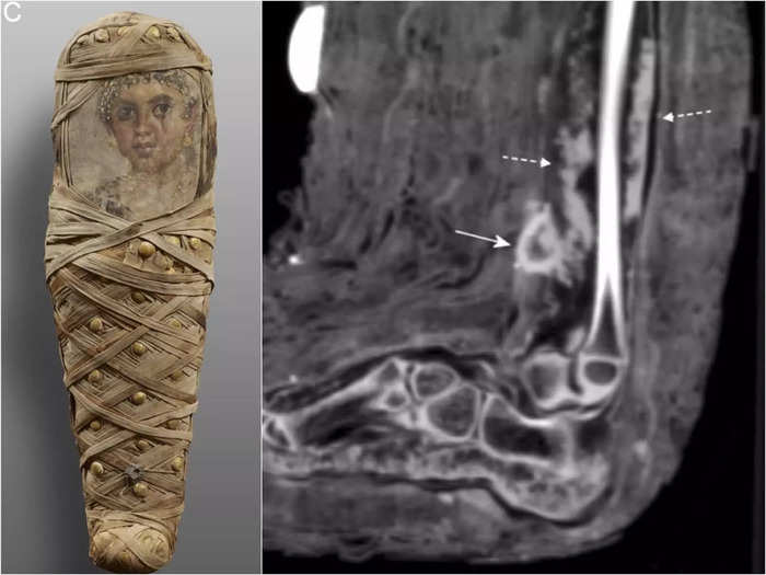 Egyptians may have treated flesh wounds with bandages.