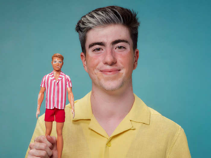 One of the Ken dolls is the first to represent a skin condition called vitiligo, when the skin loses pigment.